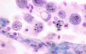 Science Immunology:巨噬細(xì)胞發(fā)育缺陷導(dǎo)致肺部疾病 Science Immunology:巨噬細(xì)胞發(fā)育缺陷導(dǎo)致肺部疾病