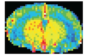 Nature Neuroscience:一種免疫蛋白可能誘發(fā)與高血壓無(wú)關(guān)的癡呆