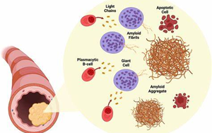 NEJM綜述:淀粉樣變性的發(fā)病機(jī)制、研究和治療